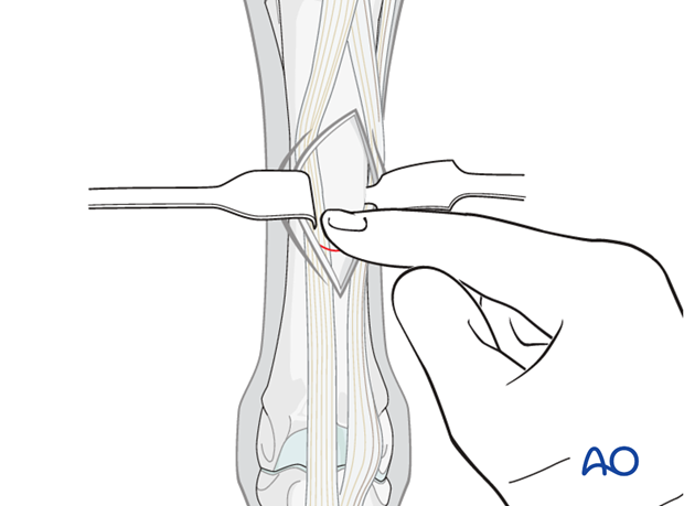 H87_O200_i180 approach to mcmtiii diaphysis