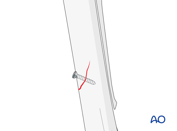 screw fixation with osteostixis