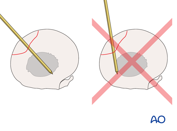 screw fixation with osteostixis