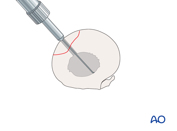 screw fixation with osteostixis