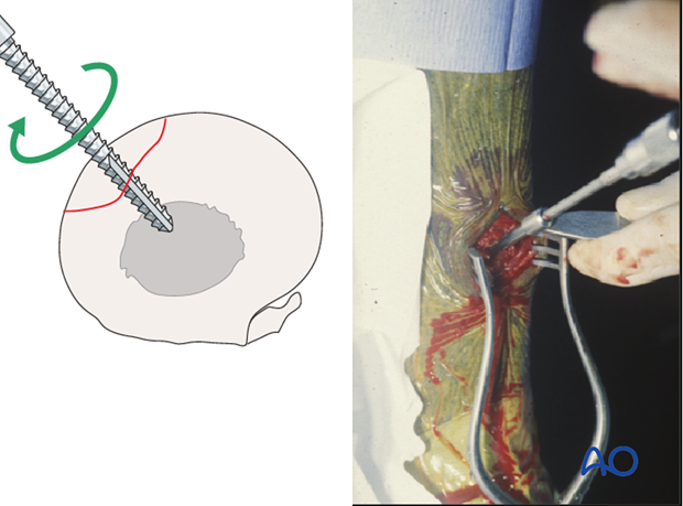 screw fixation with osteostixis