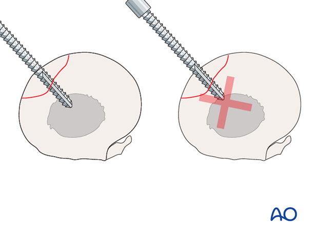 screw fixation with osteostixis