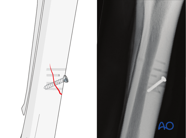 screw fixation with osteostixis