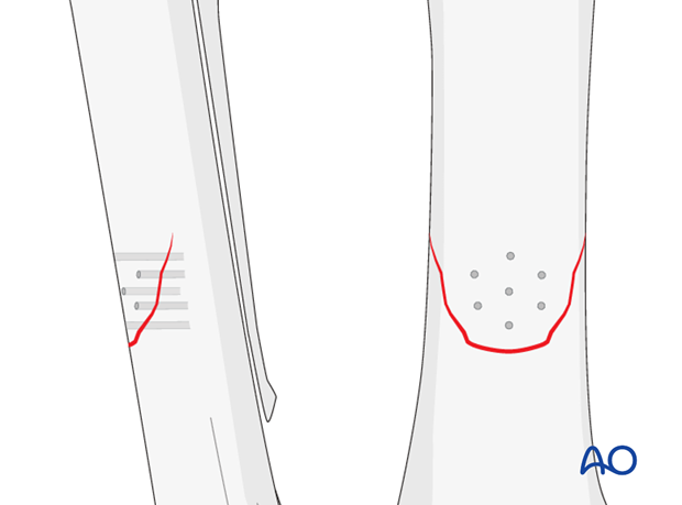 screw fixation with osteostixis