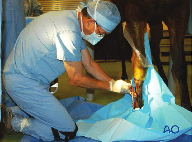 Medial incomplete condylar fracture - plate fixation