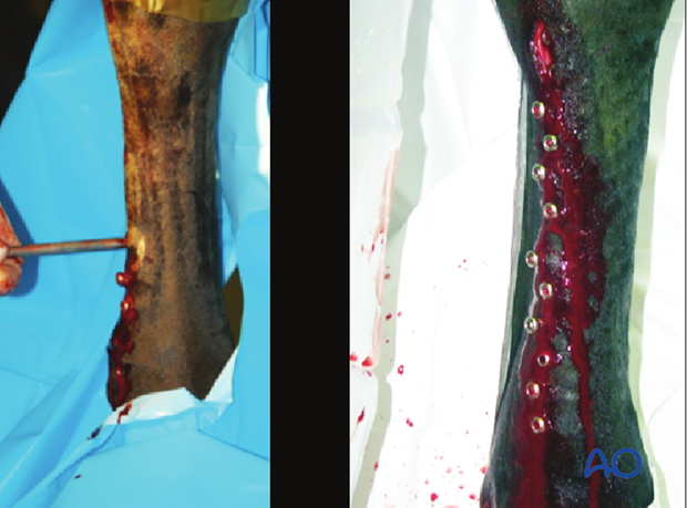 Medial incomplete condylar fracture - plate fixation