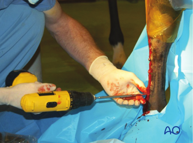 Medial incomplete condylar fracture - plate fixation