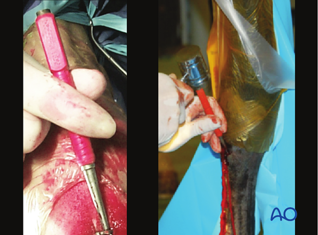 Medial incomplete condylar fracture - plate fixation