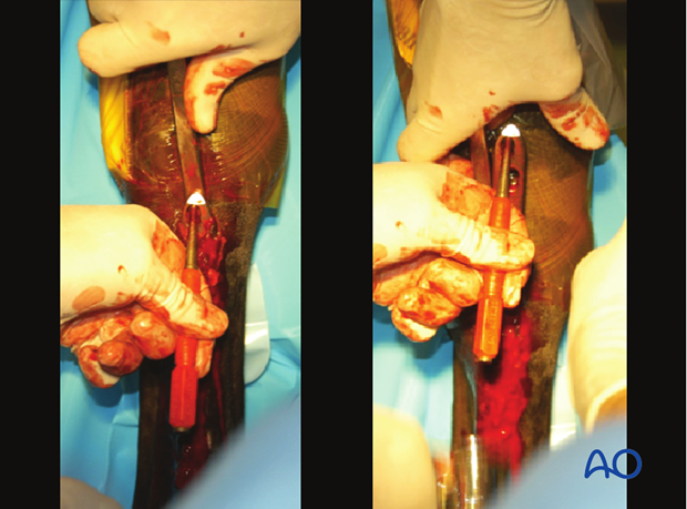 Medial incomplete condylar fracture - plate fixation