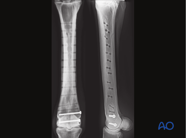 Medial incomplete condylar fracture - plate fixation