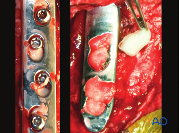 Medial incomplete condylar fracture - plate fixation