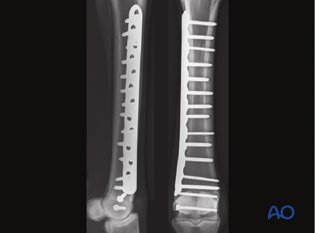 Medial incomplete condylar fracture - plate fixation