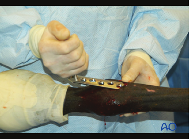 Medial incomplete condylar fracture - plate fixation