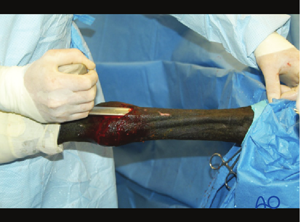 Medial incomplete condylar fracture - plate fixation