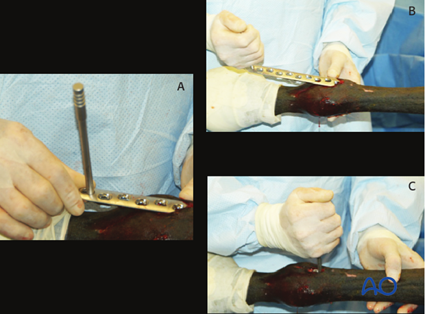 Medial incomplete condylar fracture - plate fixation