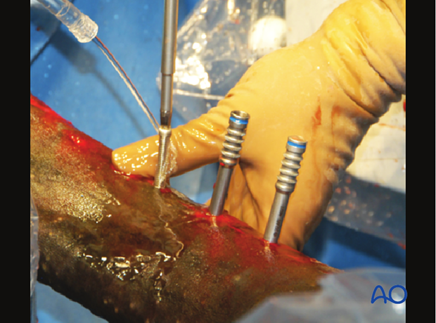 Medial incomplete condylar fracture - plate fixation