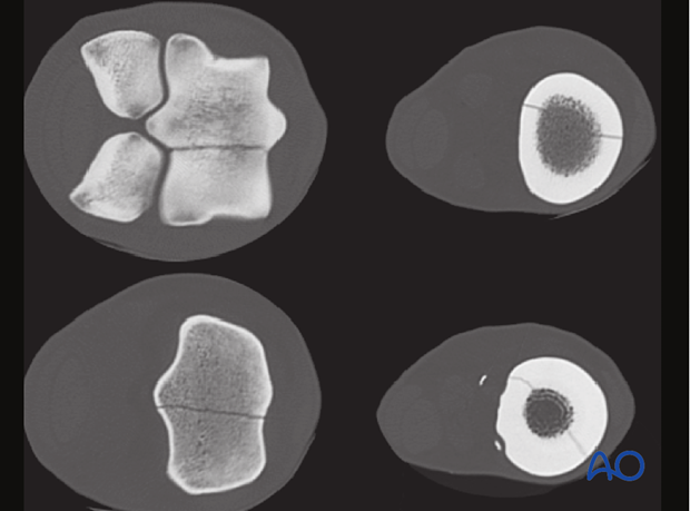 Medial spiral condylar fracture