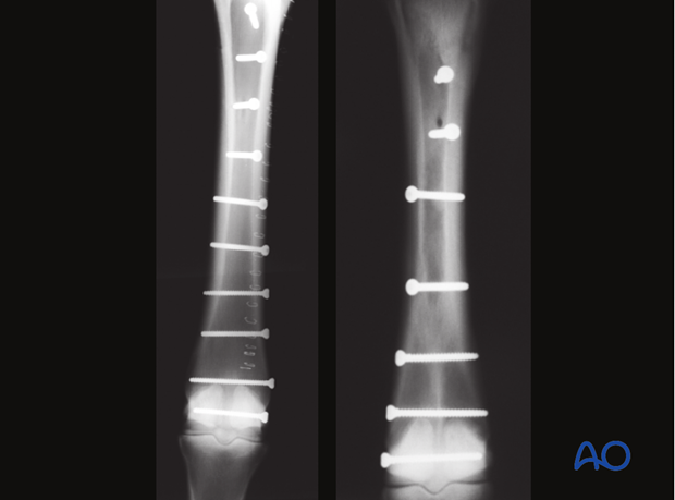 Medial spiral condylar fracture - screw fixation