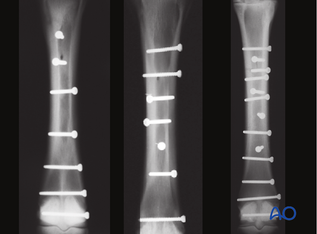 Medial spiral condylar fracture - screw fixation