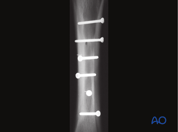 Medial spiral condylar fracture - screw fixation