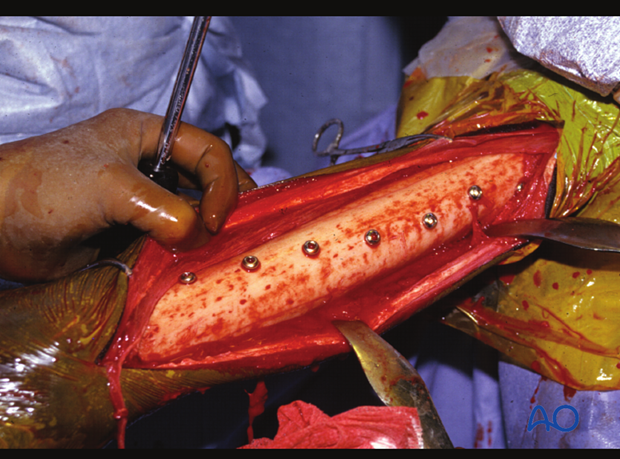 Medial spiral condylar fracture - screw fixation