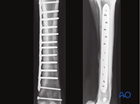 medial condyle spiral fractures