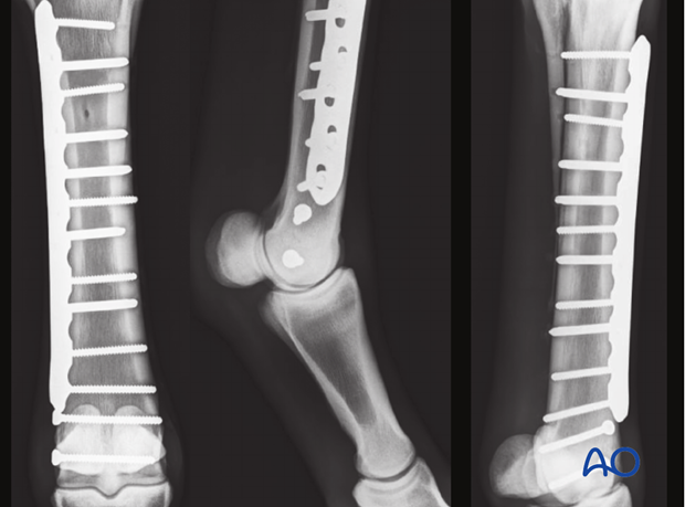 Medial spiral condylar fracture - plate fixation