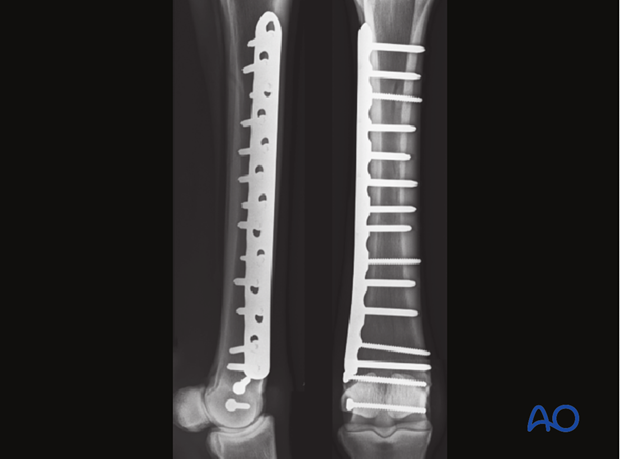 Medial spiral condylar fracture - plate fixation