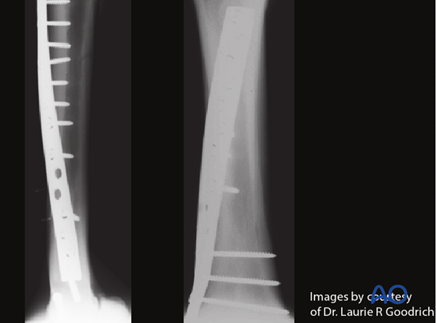 Medial spiral condylar fracture - plate fixation