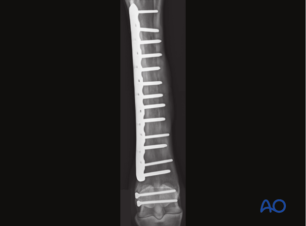 plate fixation