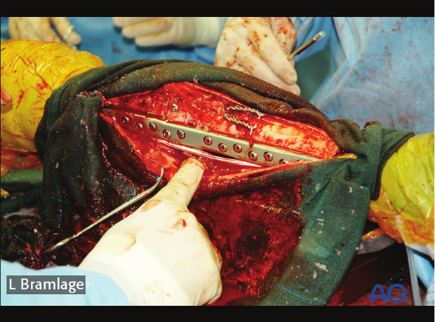 arthrodesis tension bad using wires or the sesamoid bones