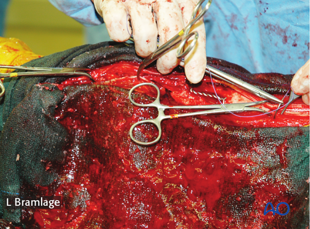 arthrodesis tension bad using wires or the sesamoid bones