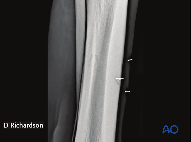 H87_Prep200_p010 approach to mcmtiii diaphysis