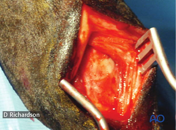H87_Prep200_p020 approach to mcmtiii diaphysis