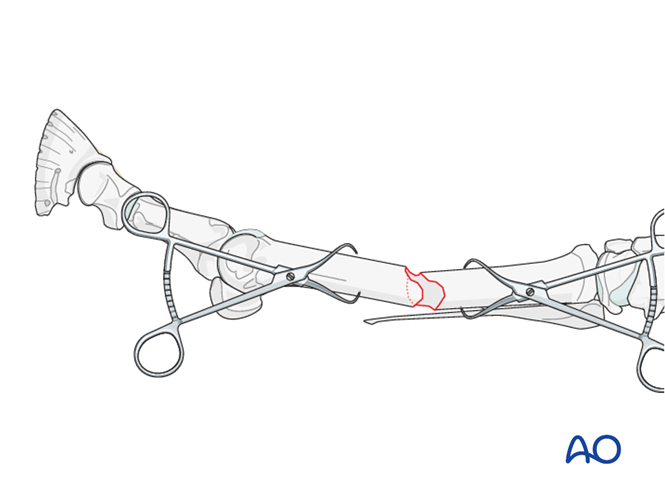 Fixation with plates and screws for Metacarpals/-tarsals III ...