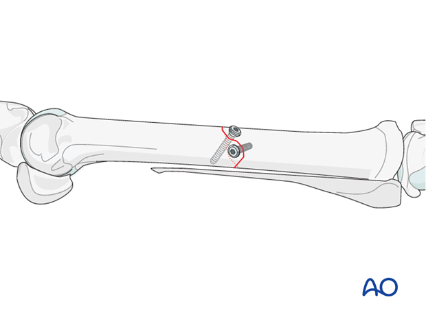 fixation with plates and screws