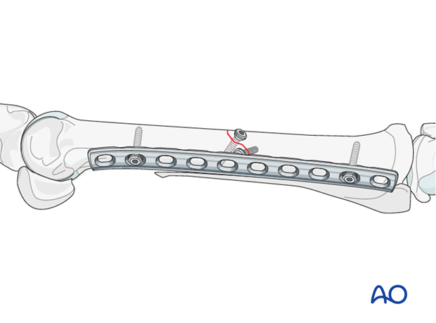 fixation with plates and screws