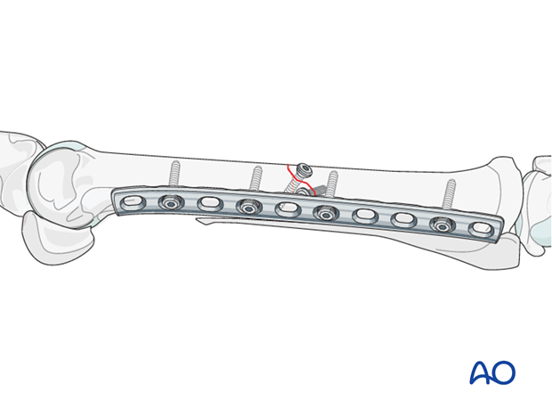 fixation with plates and screws
