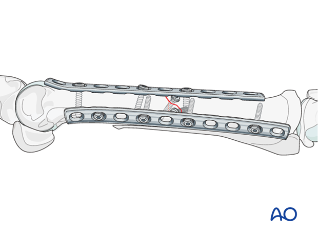 fixation with plates and screws
