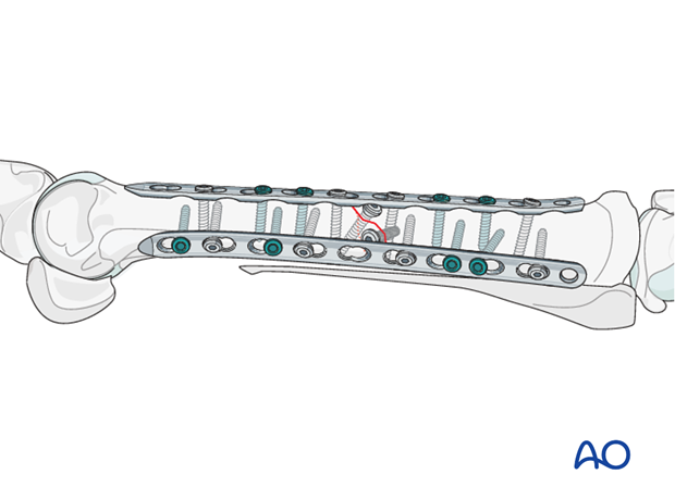 fixation with plates and screws