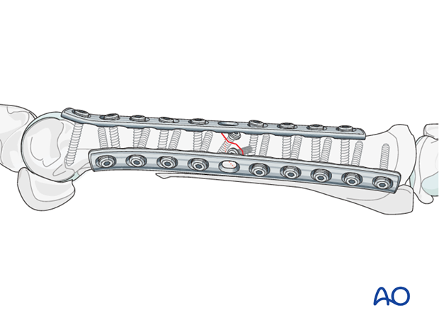 fixation with plates and screws