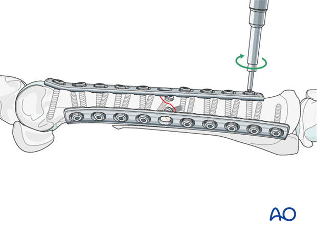 fixation with plates and screws