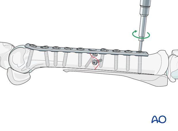fixation with plates and screws