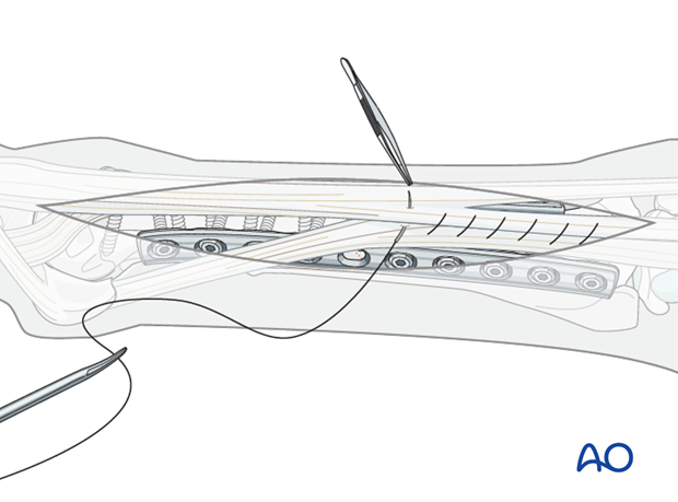fixation with plates and screws