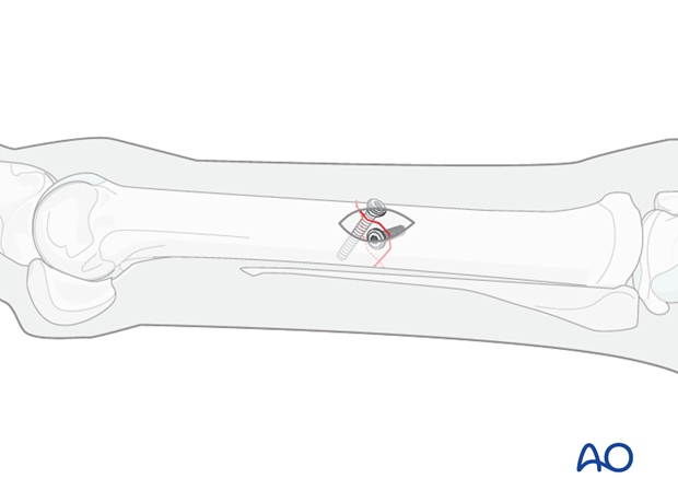 stab incision for minimally invasive fixation