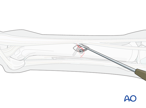 minimally invasive fixation