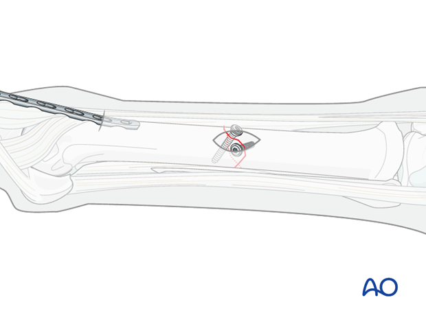 minimally invasive fixation