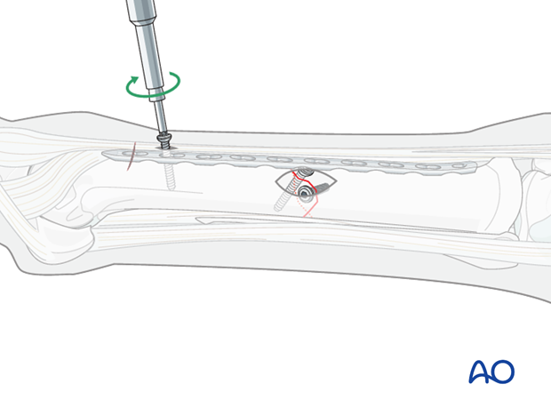 minimally invasive fixation