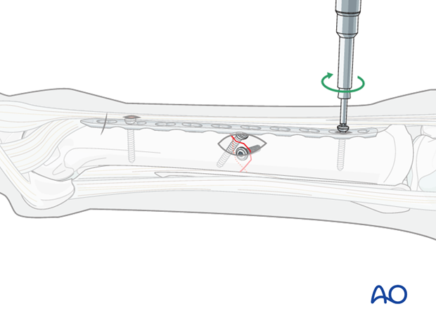 minimally invasive fixation