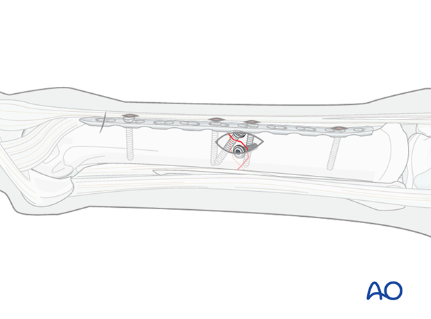 minimally invasive fixation